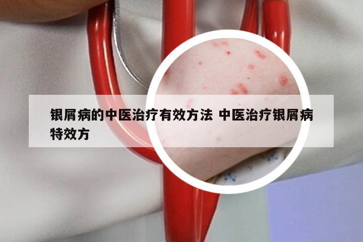 银屑病的中医治疗有效方法 中医治疗银屑病特效方