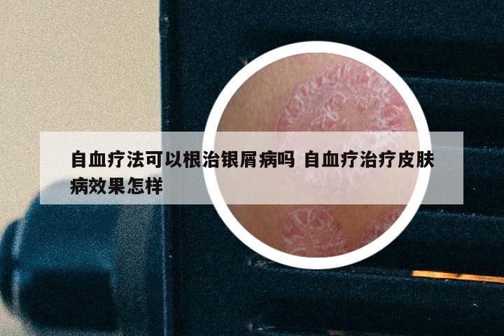 自血疗法可以根治银屑病吗 自血疗治疗皮肤病效果怎样