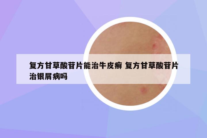 复方甘草酸苷片能治牛皮癣 复方甘草酸苷片治银屑病吗