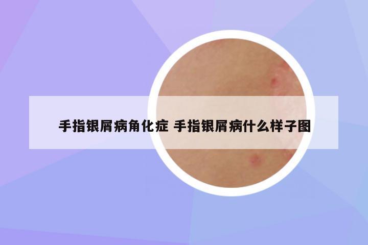 手指银屑病角化症 手指银屑病什么样子图