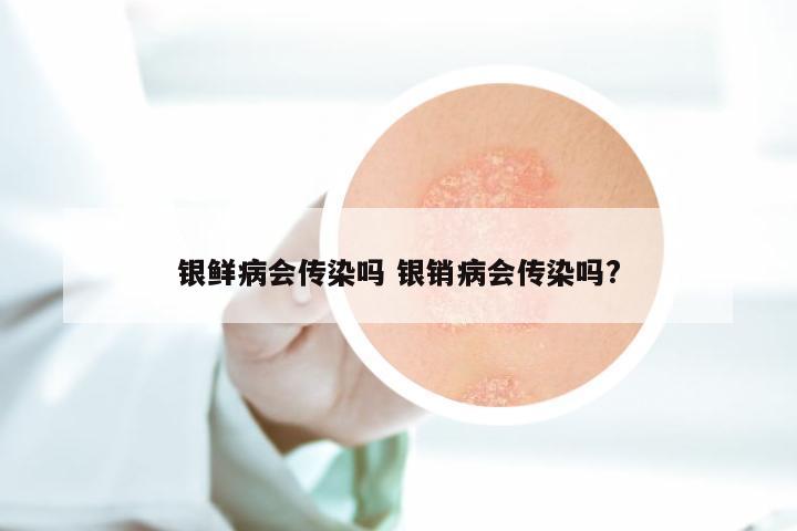 银鲜病会传染吗 银销病会传染吗?