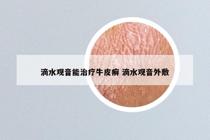 滴水观音能治疗牛皮癣 滴水观音外敷