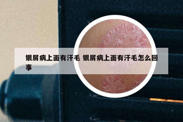 银屑病上面有汗毛 银屑病上面有汗毛怎么回事