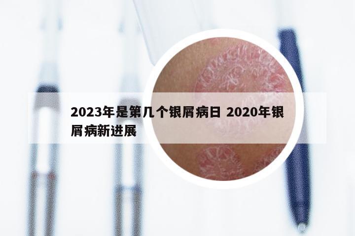 2023年是第几个银屑病日 2020年银屑病新进展