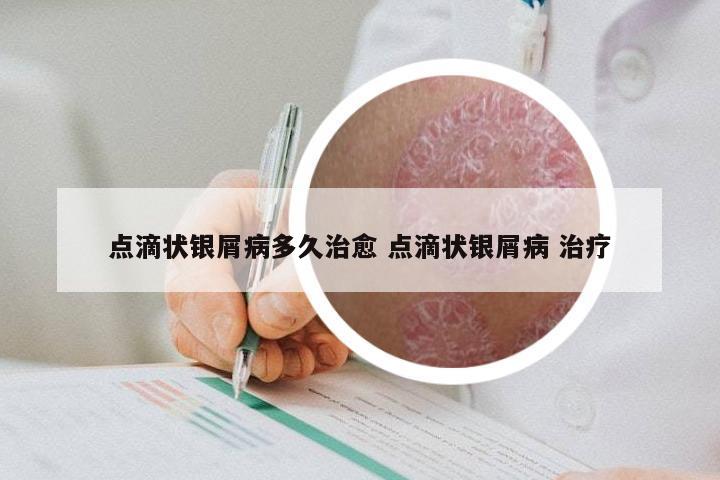 点滴状银屑病多久治愈 点滴状银屑病 治疗