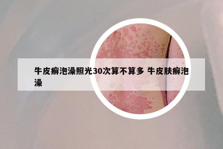 牛皮癣泡澡照光30次算不算多 牛皮肤癣泡澡