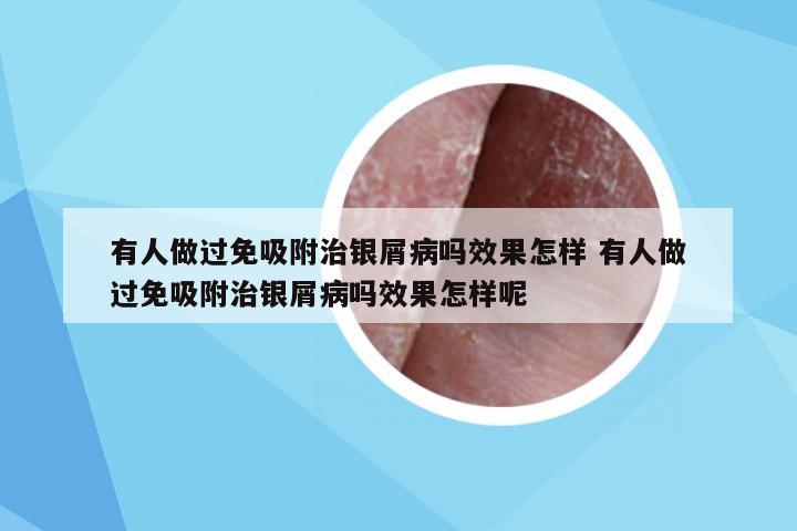 有人做过免吸附治银屑病吗效果怎样 有人做过免吸附治银屑病吗效果怎样呢