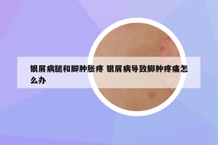 银屑病腿和脚肿胀疼 银屑病导致脚肿疼痛怎么办