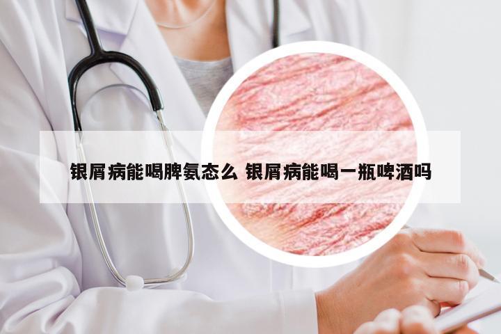 银屑病能喝脾氨态么 银屑病能喝一瓶啤酒吗