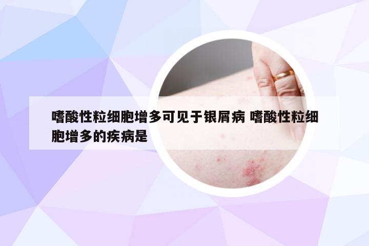 嗜酸性粒细胞增多可见于银屑病 嗜酸性粒细胞增多的疾病是