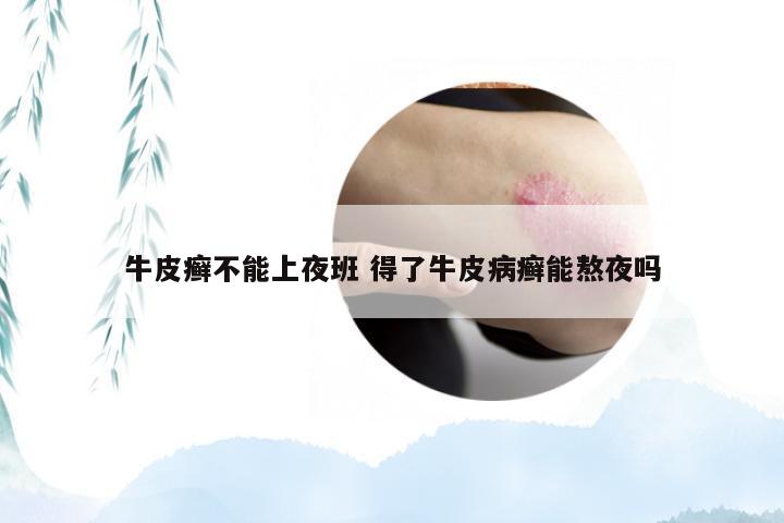 牛皮癣不能上夜班 得了牛皮病癣能熬夜吗