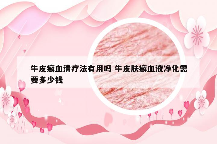 牛皮癣血清疗法有用吗 牛皮肤癣血液净化需要多少钱