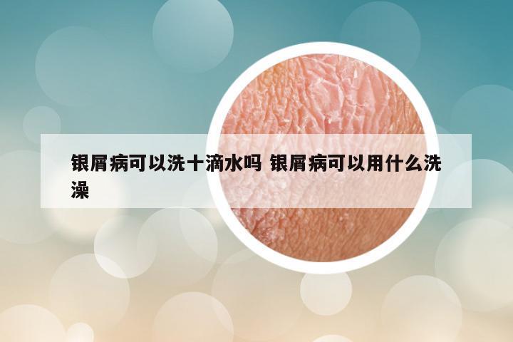 银屑病可以洗十滴水吗 银屑病可以用什么洗澡