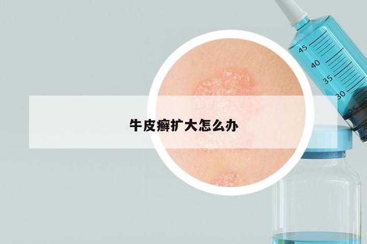 牛皮癣扩大怎么办