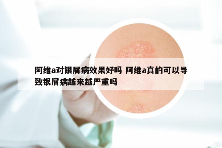 阿维a对银屑病效果好吗 阿维a真的可以导致银屑病越来越严重吗