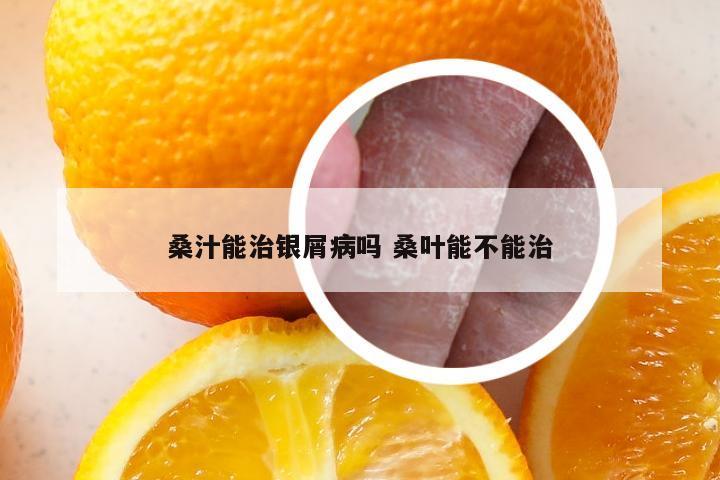 桑汁能治银屑病吗 桑叶能不能治