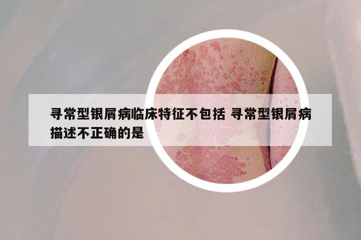 寻常型银屑病临床特征不包括 寻常型银屑病描述不正确的是