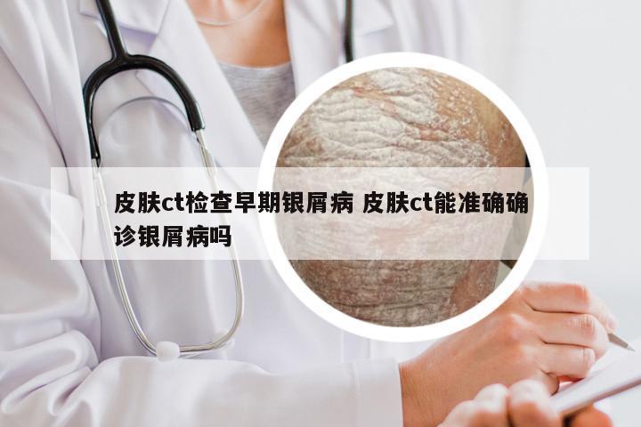 皮肤ct检查早期银屑病 皮肤ct能准确确诊银屑病吗