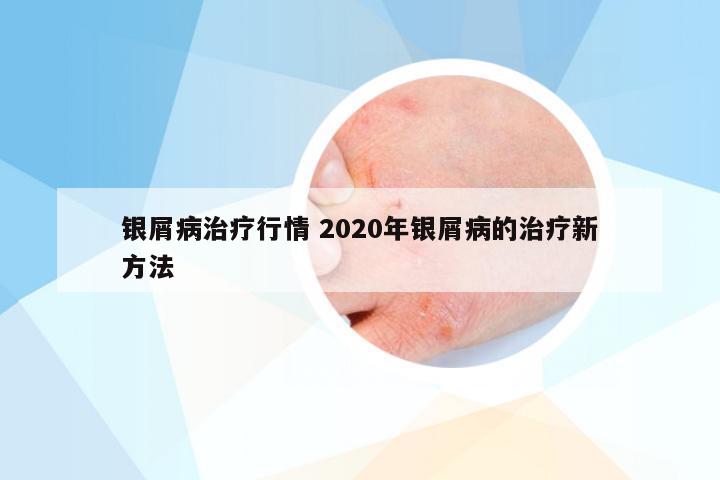 银屑病治疗行情 2020年银屑病的治疗新方法