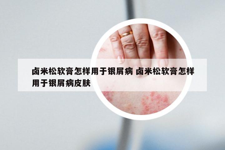卤米松软膏怎样用于银屑病 卤米松软膏怎样用于银屑病皮肤