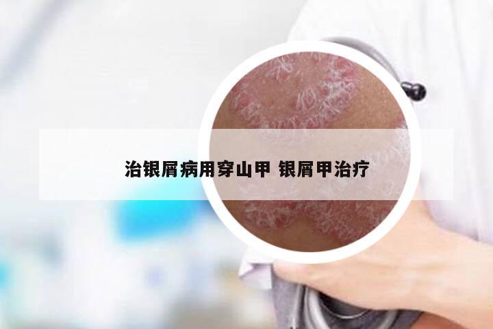 治银屑病用穿山甲 银屑甲治疗