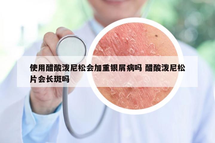 使用醋酸泼尼松会加重银屑病吗 醋酸泼尼松片会长斑吗