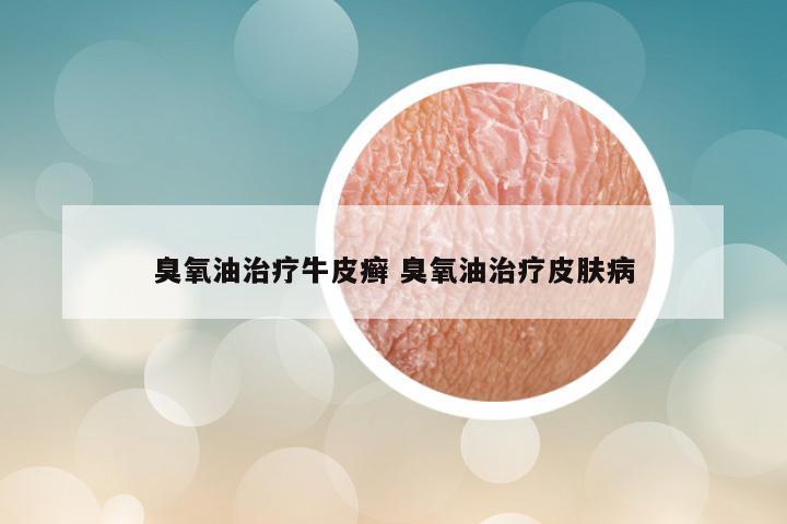 臭氧油治疗牛皮癣 臭氧油治疗皮肤病