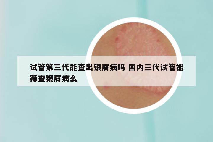 试管第三代能查出银屑病吗 国内三代试管能筛查银屑病么
