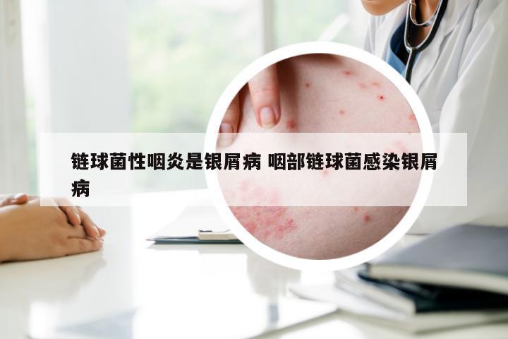 链球菌性咽炎是银屑病 咽部链球菌感染银屑病