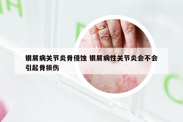 银屑病关节炎骨侵蚀 银屑病性关节炎会不会引起骨损伤