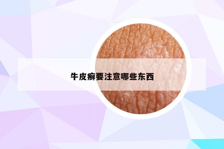 牛皮癣要注意哪些东西