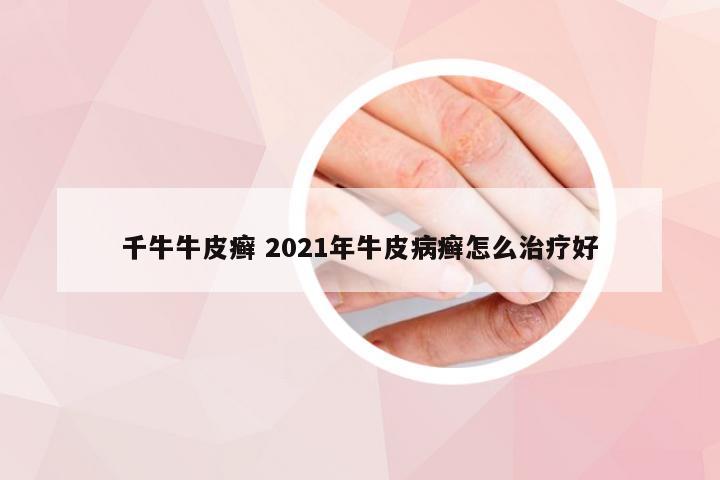 千牛牛皮癣 2021年牛皮病癣怎么治疗好