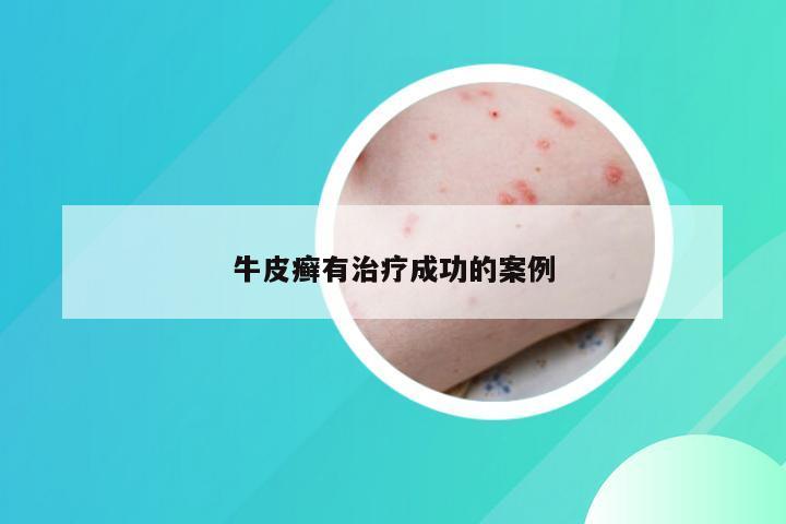 牛皮癣有治疗成功的案例