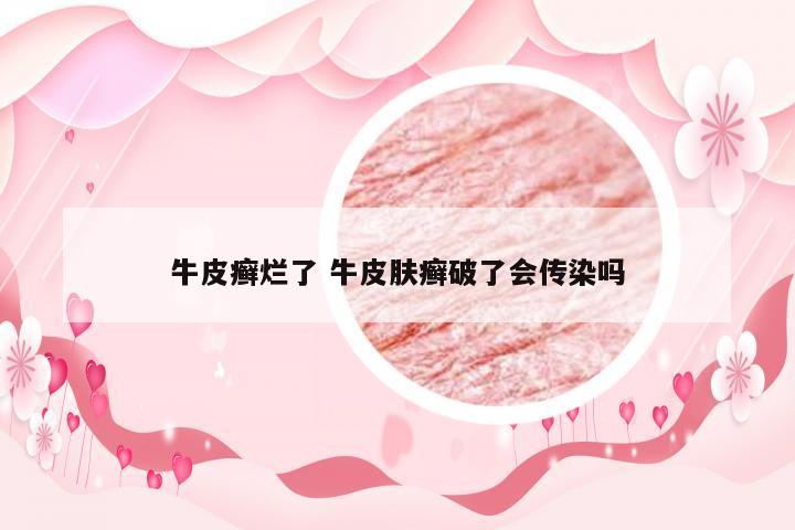 牛皮癣烂了 牛皮肤癣破了会传染吗