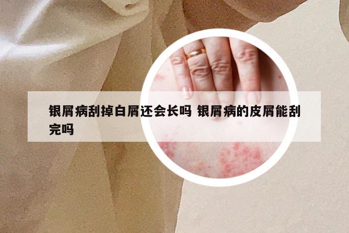 银屑病刮掉白屑还会长吗 银屑病的皮屑能刮完吗