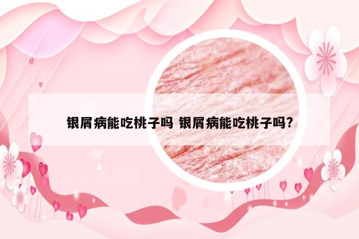 银屑病能吃桃子吗 银屑病能吃桃子吗?