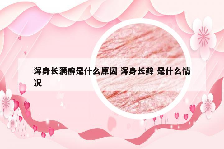浑身长满癣是什么原因 浑身长藓 是什么情况