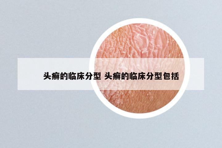 头癣的临床分型 头癣的临床分型包括