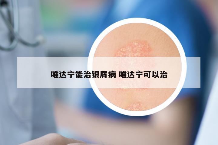 唯达宁能治银屑病 唯达宁可以治