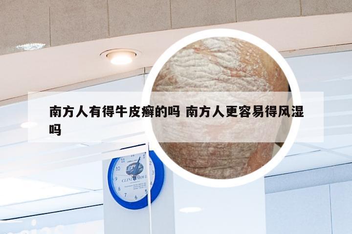 南方人有得牛皮癣的吗 南方人更容易得风湿吗