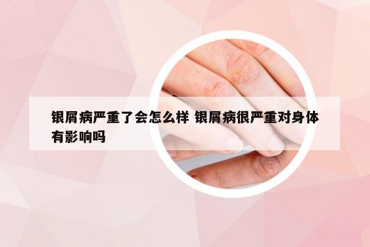 银屑病严重了会怎么样 银屑病很严重对身体有影响吗