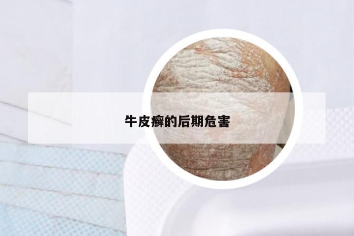 牛皮癣的后期危害
