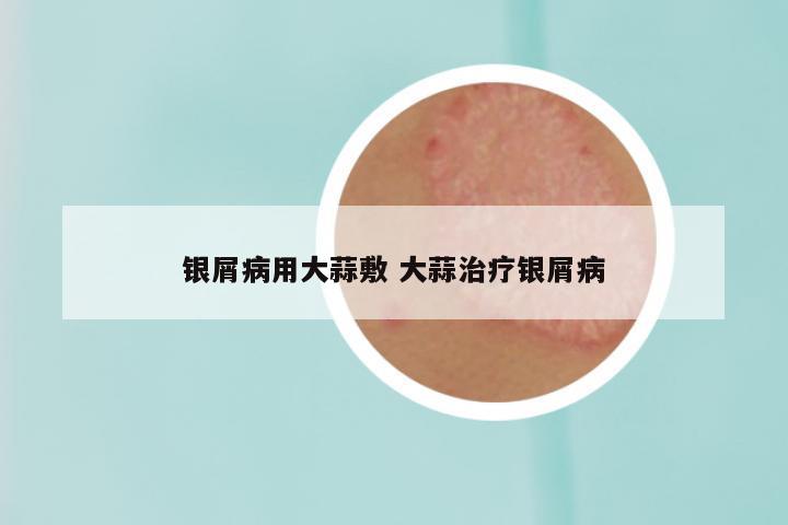 银屑病用大蒜敷 大蒜治疗银屑病
