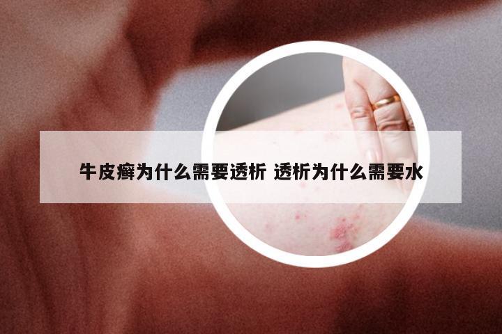 牛皮癣为什么需要透析 透析为什么需要水