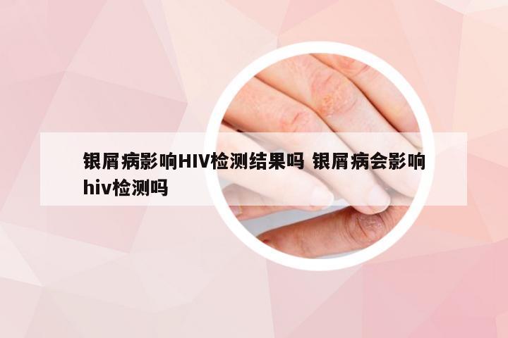 银屑病影响HIV检测结果吗 银屑病会影响hiv检测吗