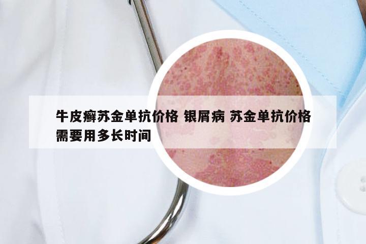 牛皮癣苏金单抗价格 银屑病 苏金单抗价格需要用多长时间