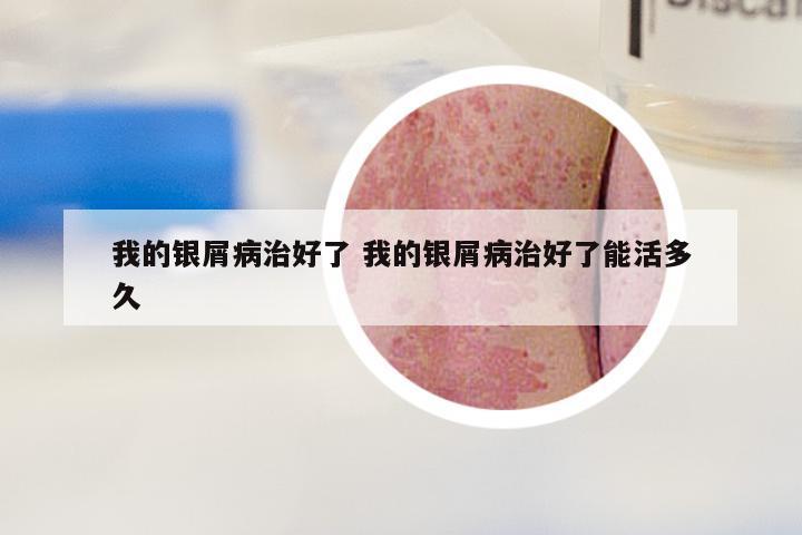 我的银屑病治好了 我的银屑病治好了能活多久