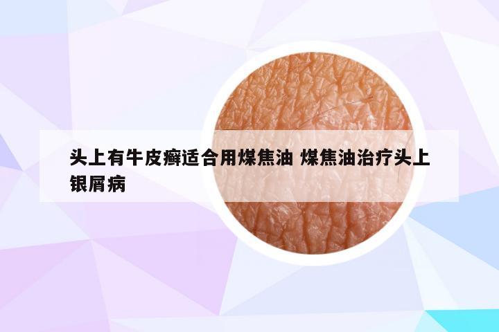 头上有牛皮癣适合用煤焦油 煤焦油治疗头上银屑病
