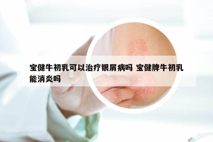宝健牛初乳可以治疗银屑病吗 宝健牌牛初乳能消炎吗