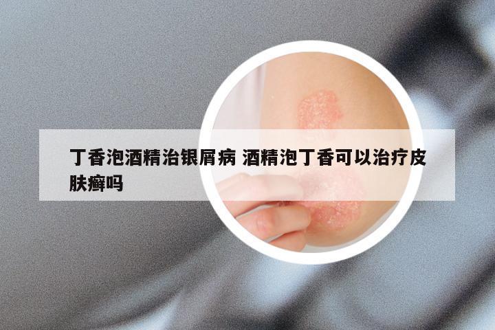 丁香泡酒精治银屑病 酒精泡丁香可以治疗皮肤癣吗